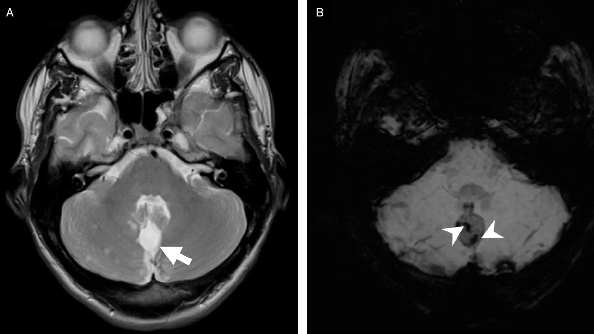 Tumores glioneuronales, hallazgos clave y enfoque práctico en RM