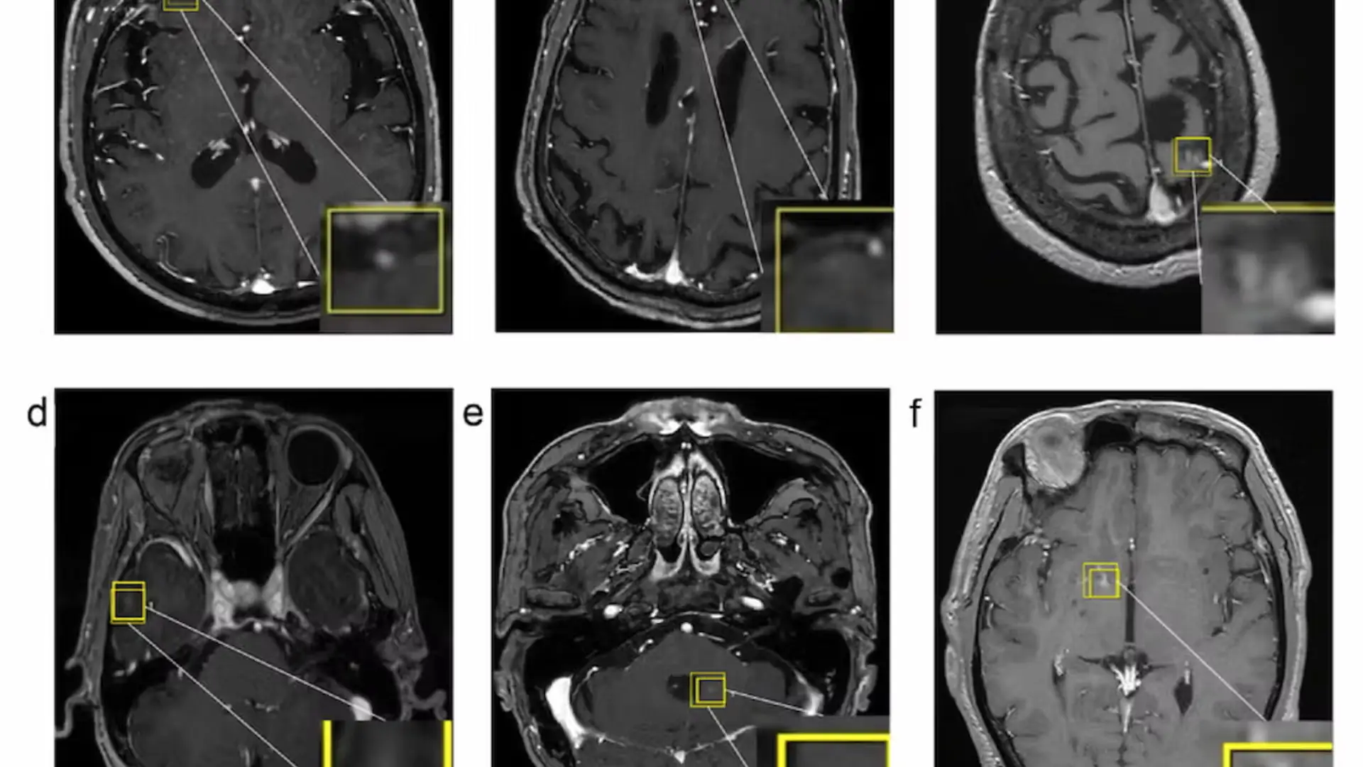IA mejora la detección de metástasis cerebrales y reduce el tiempo de lectura