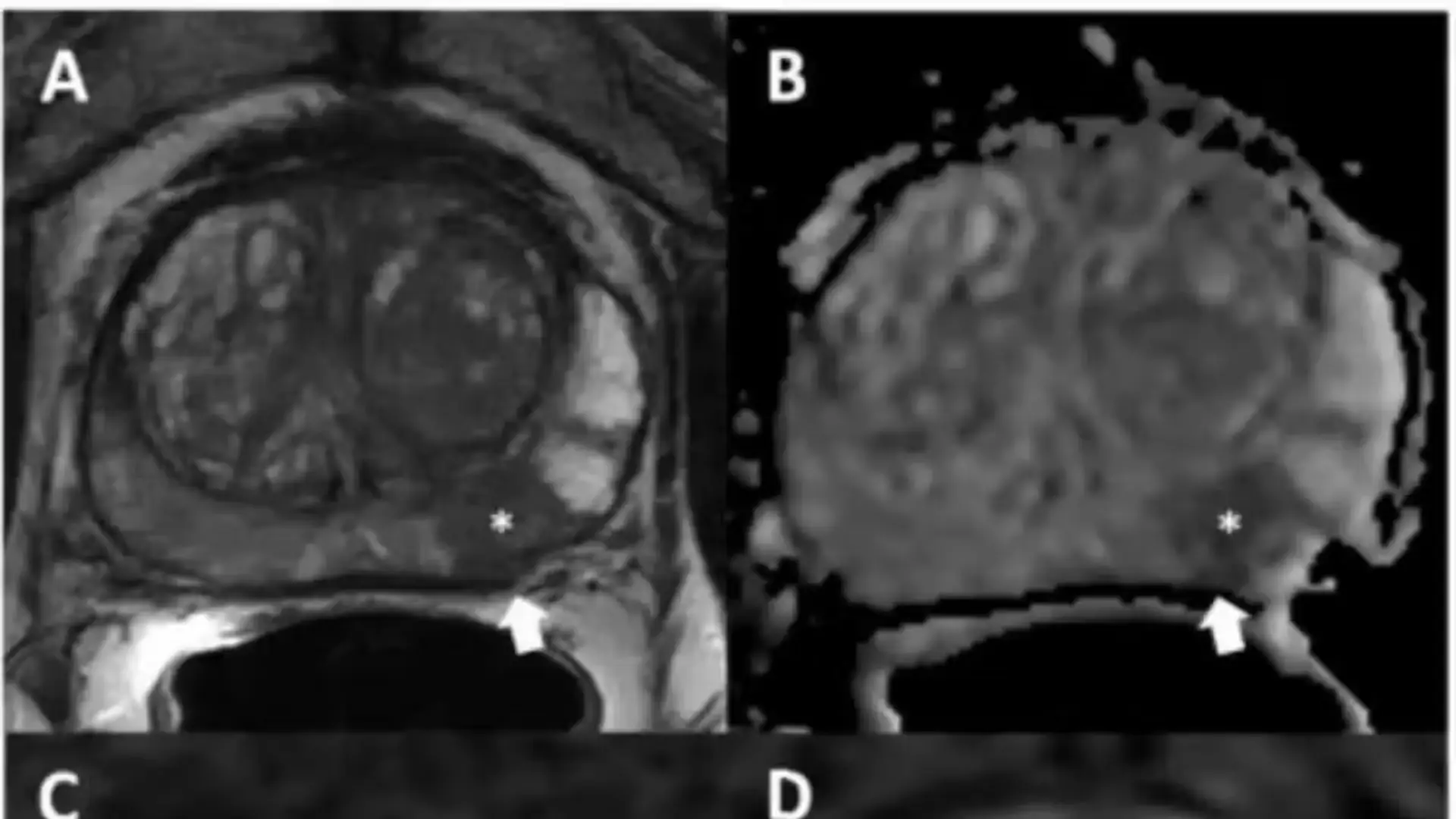 RM de próstata antes de la prostatectomía: recaída, metástasis y mortalidad