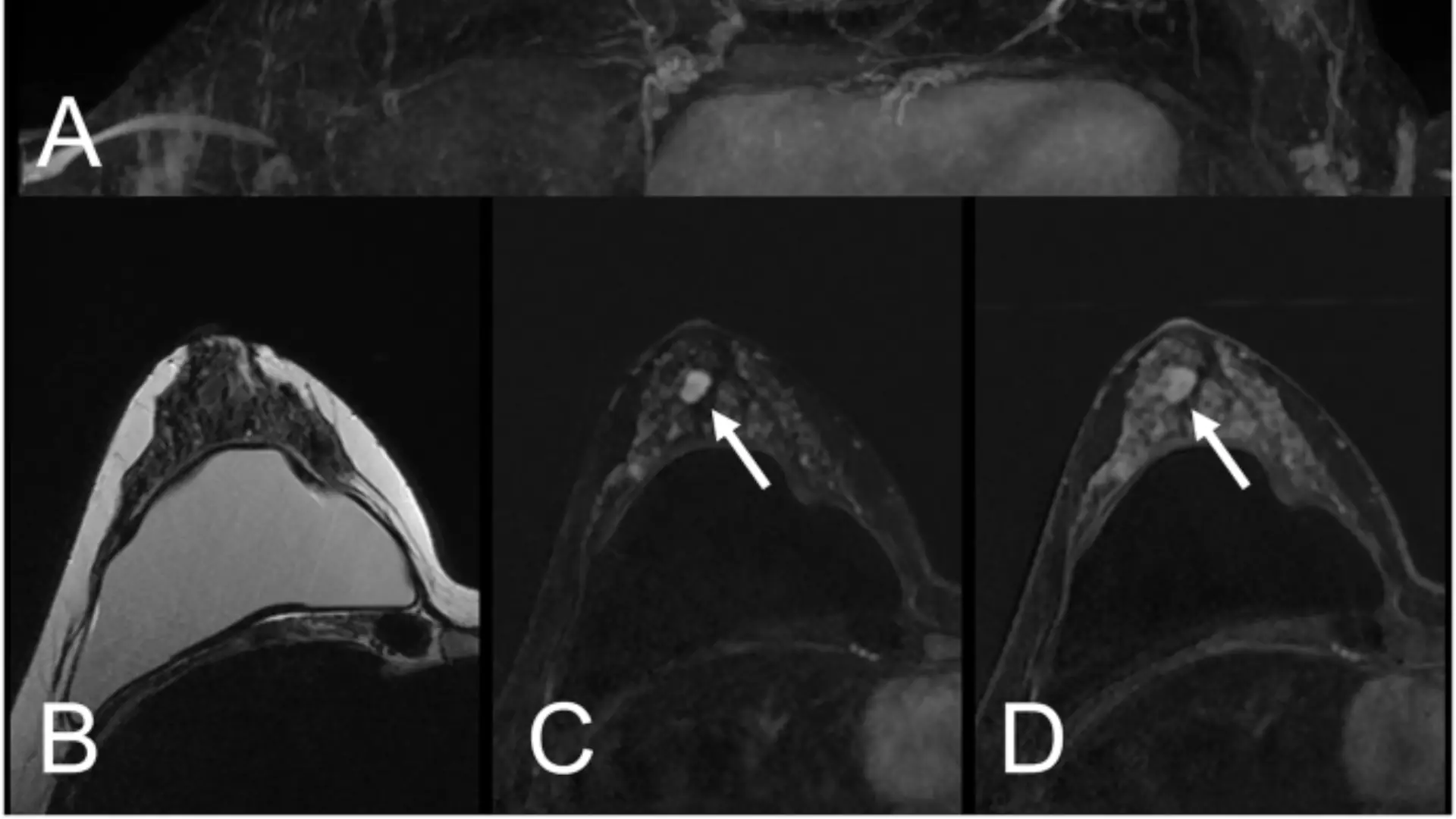 El realce de fondo en resonancia mamaria no reduce la detección de lesiones