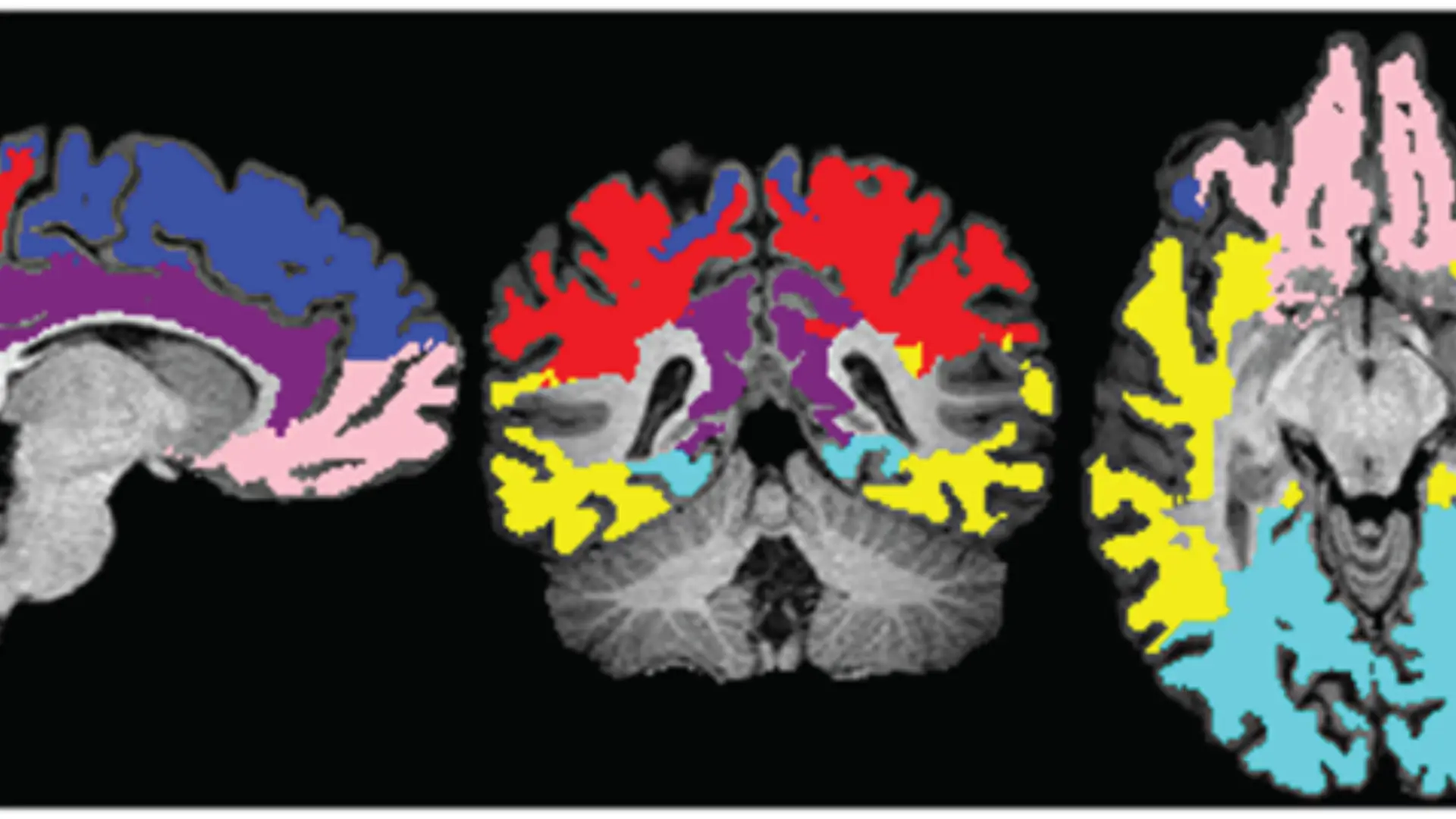 Cabezazos en el fútbol y cambios microestructurales cerebrales