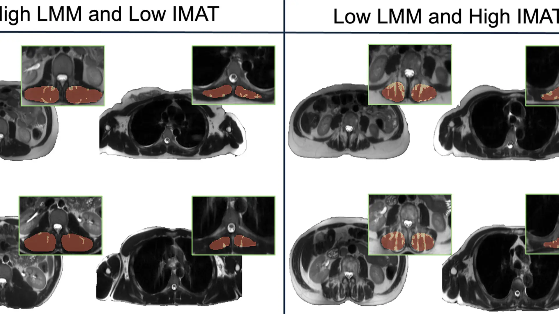 Resonancia: la grasa intermuscular podría anticipar riesgo cardiometabólico