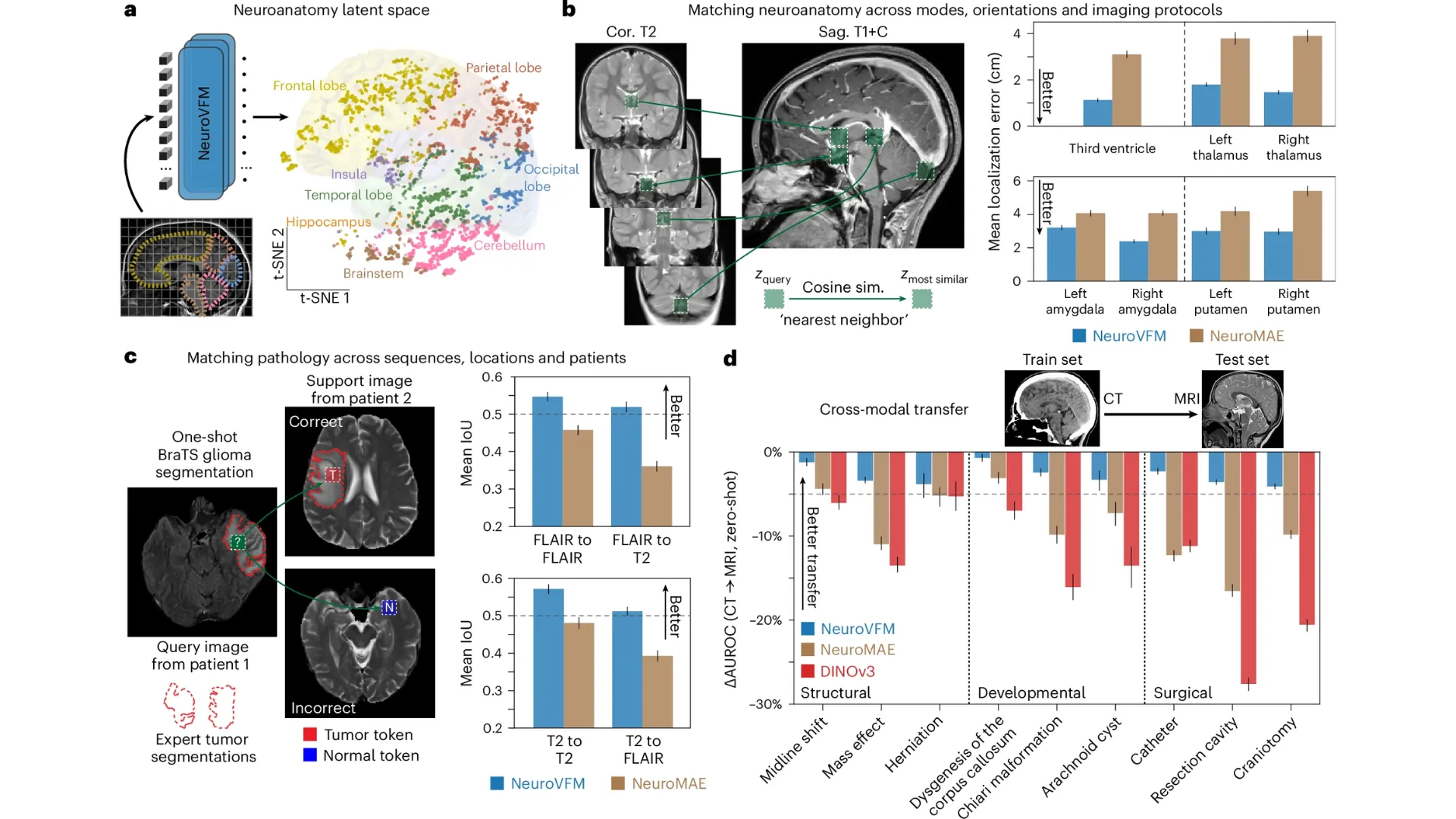 NeuroVFM: la IA entrenada en datos clínicos que supera a GPT-5 en neuroimagen